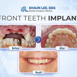 Shaun Lee DDS: Dental Implant and General Dentistry of Auburn - Case Study: Front Teeth Implant
