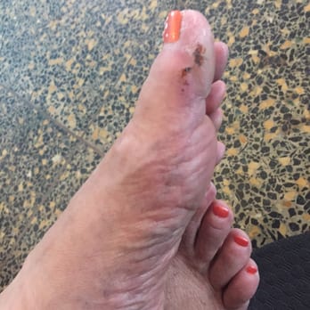 Nail Tech - After a challis removal, this was the result. Covered by a serum that stung badly & kept the toes from bleeding in the salon. - Hair Removal Near Me - Hilo, Hawaii Nail Tech - After a challis removal, this was the result. Covered by a serum that stung badly & kept the toes from bleeding in the salon. - Hair Removal Near Me - Hilo, Hawaii