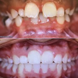 Toothworks of Bakersfield - Before and after braces with Dr. B !