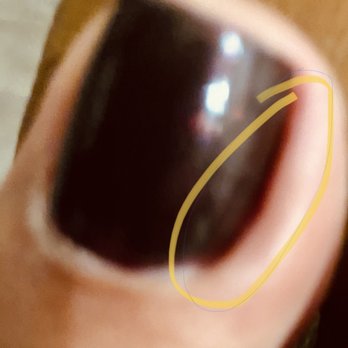 Classy Nails Bar - Swollen and it hurts ALOT! - Nail Salons Near Me - Norco, California Classy Nails Bar - Swollen and it hurts ALOT! - Nail Salons Near Me - Norco, California