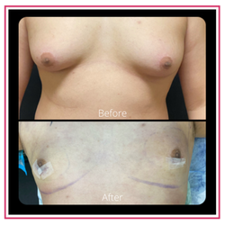 Pasqual Bracero, MD - Orlando Center For Womens Health - Gynecomastia (Male Breast Reduction)