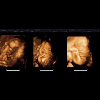 Stork Vision Frisco - 17 weeks | 28 weeks | 34 weeks - Diagnostic Imaging Near Me - Frisco, Texas Stork Vision Frisco - 17 weeks | 28 weeks | 34 weeks - Diagnostic Imaging Near Me - Frisco, Texas