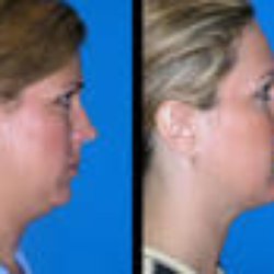 Clymer Facial Plastic Surgery - Neck Contouring Before and After - Neck Plastic Surgery