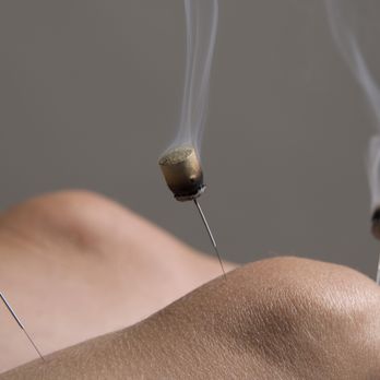 Bespoke Acupuncture - Acupuncture Near Me - Islington, XGL