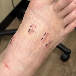 Puget Sound Orthopaedics - Lakewood - Second post-op suture set. Wrinkly from my bandage wrap  lol