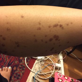 Defining Beauty - Stay away from this lady! Bernadette (owner) is not a professional laser technician as she so claims. She has caused severe skin damage!!!!! - Tattoo Removal Near Me - Greenville, New York