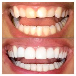 Denture and Dental Services - Before and After Veneers at Denture and Dental Services in Destin, Florida.   More information at www.DestinDentures.com