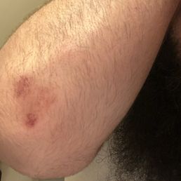 Be careful! That multi color tube slide is nuts! I got this bruise because it had me going backwards at a ridiculous speed! Be careful! That multi color tube slide is nuts! I got this bruise because it had me going backwards at a ridiculous speed!
