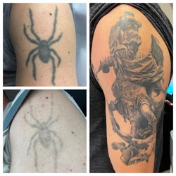 Bonsai Laser Tattoo Removal