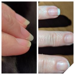 Nails Now - Before: strong and healthy After: broken, brittle & thin with indent marks from drill
