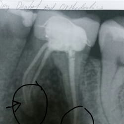 Denton Family Dental Clinic - Root canal done wrong! Supposed to be at the end of root. Not past