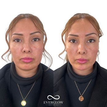 EverGlow Aesthetics - Lower facial balancing with Botox and Fillers - Medical Spas Near Me - Tustin, California