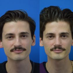 Samir S Undavia, MD - Rhinoplasty & Septoplasty