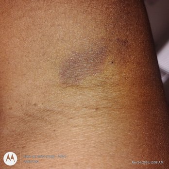 ER at blue diamond - An ugly bruise from the 2nd needle stick. Idk what's going on. - Emergency Rooms Near Me - Las Vegas, Nevada ER at blue diamond - An ugly bruise from the 2nd needle stick. Idk what's going on. - Emergency Rooms Near Me - Las Vegas, Nevada