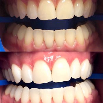 Everything Teeth - Miami - Zoom Whitening ! So happy with my results :) - General Dentistry Near Me - Miami, Florida