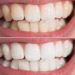 Sparkle Teeth Whitening