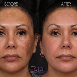 Total Dermatology - Patient was treated with Cosmelan for melasma.