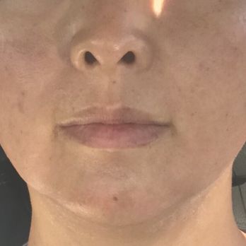 StepUp To Wellness - After PRP with Micro-Needling - Medical Spas Near Me - Chandler, Arizona