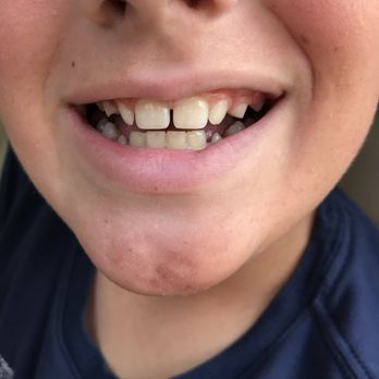 Eli Orthodontics - Before photo - Orthodontists Near Me - Lake Forest, California