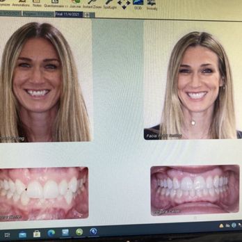 Brand Orthodontics - Before & After! - Orthodontists Near Me - San Diego, California Brand Orthodontics - Before & After! - Orthodontists Near Me - San Diego, California