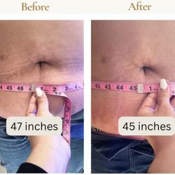 Rose Wellness and Spa - 2 inches lost on stomach after 1 Shape treatment. No pain and no downtime!