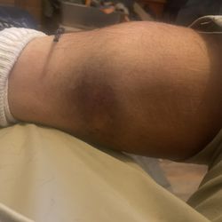 Asante Rogue Regional Medical Center - The bruising that my sciatica causes from the muscles balling up. Zero contact injury.