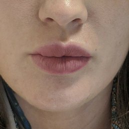 Lips after Darma art lip filler Lips after Darma art lip filler