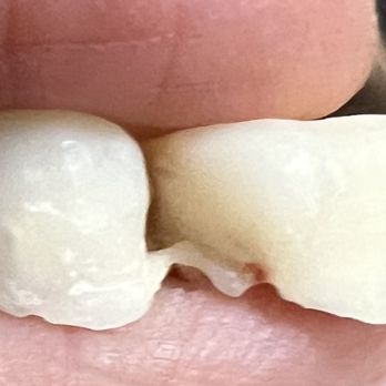 Canyon Pointe Dental Group - outer view of horribly shaped and extra unnecessary pieces - General Dentistry Near Me - Las Vegas, Nevada Canyon Pointe Dental Group - outer view of horribly shaped and extra unnecessary pieces - General Dentistry Near Me - Las Vegas, Nevada