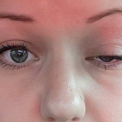 Purity Medical Spa - Beware botched botox from this place, don't ever go here it's not safe to let these people near your face, you're too beautiful to risk it.