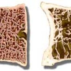 Colorado Comprehensive Spine Institute - Osteoporosis is also called fragile bone disease