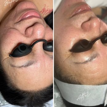 Radiance Spa - Chemical Peel Results - Estheticians Near Me - Modesto, California Radiance Spa - Chemical Peel Results - Estheticians Near Me - Modesto, California
