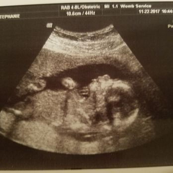 Womb Service 3D/4D Ultrasound Studio - Diagnostic Imaging Near Me - Audubon, New Jersey Womb Service 3D/4D Ultrasound Studio - Diagnostic Imaging Near Me - Audubon, New Jersey