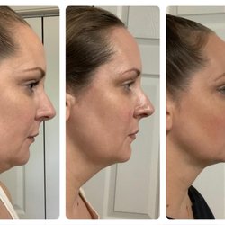 Trio Skincare - Kybella Before & After
.These results by our nurse speak for themselves. Kybella is an injectable treatment that destroys fat cells.