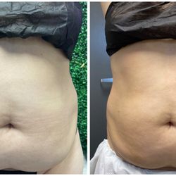 Bella Eternity Studio - 2nd treatment before & after