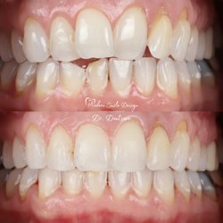 Invisalign Before and After at Modern Smile Design