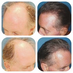 Meshkin Medical - Hair Restoration Clinic - Grade 6 hairloss, 3500grafts done using FUT harvesting and ultra refined microscopic grafting.