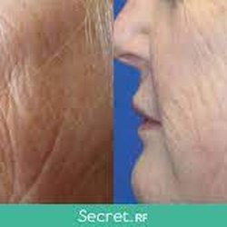 Rosario Skin Care - AMAZING results with SecretRF! Microneedling with RF.