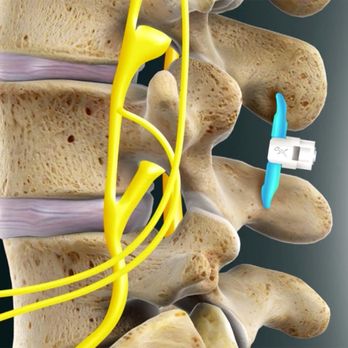 North Shore Pain Management - Vertiflex Interspinous Spacer - A procedure to decompress the nerves being pinched by lumbar spinal stenosis. - Pain Management Near Me - Beverly, Massachusetts North Shore Pain Management - Vertiflex Interspinous Spacer - A procedure to decompress the nerves being pinched by lumbar spinal stenosis. - Pain Management Near Me - Beverly, Massachusetts