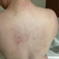 Massage Angeltips - Bruising left from a massage
