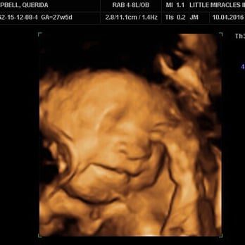 Little Miracles Imaging - This is an early 3D scan that I had done at 20something weeks. I'd recommend waiting until 30 weeks but my relatives were in town. - Diagnostic Imaging Near Me - Fayetteville, North Carolina