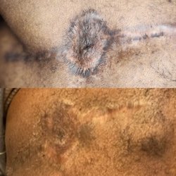 OM SPA - Cosmetic Tattoo Make up & Skin Care Clinic - Magic Eraser hyperpigmentation treatment