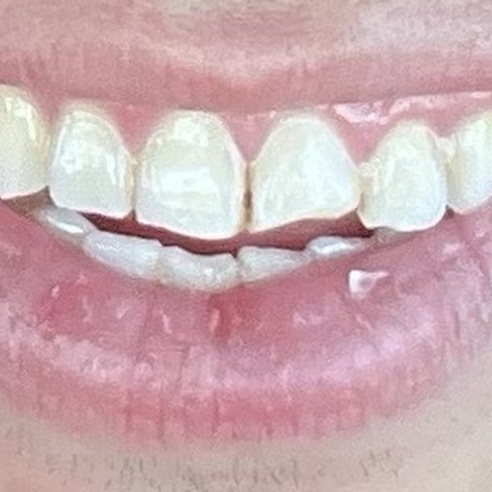 Jin's Dental Care - Before the tooth fracture filler - General Dentistry Near Me - Riverside, California