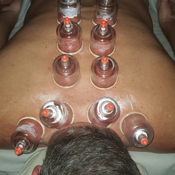 Massage Artistry - Cupping!! SO effective on my tight shoulders. - Massage Therapy Near Me Massage Artistry - Cupping!! SO effective on my tight shoulders. - Massage Therapy Near Me
