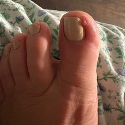 Pretty Nails - Missing skin from pedicure