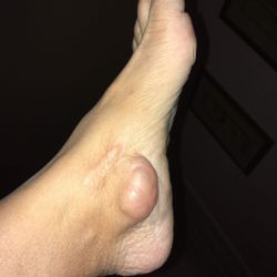 Acupuncture Thousand Branches  - The cyst would fill up with a clear gel-like goo that I had to "deflate" at the doctors office or expensive foot surgery.