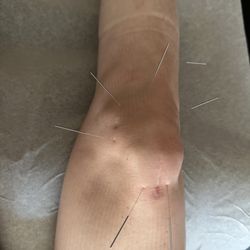 Winer Acupuncture - Post surgical knee treatment has been very effective