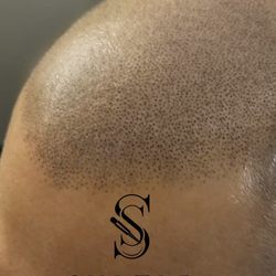 Subtle Solutions Scalp Micropigmentation - Dark density fill