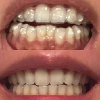 Erik Swanson Orthodontics - Before and after - Orthodontists Near Me - Los Gatos, California Erik Swanson Orthodontics - Before and after - Orthodontists Near Me - Los Gatos, California