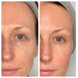 ALXS SKN GYM - Before and After (3) Pixel8 Microneedling with RadioFrequency around the eyes.