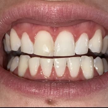Richard Haber, DDS - Before veneers from Dr.Haber - General Dentistry Near Me - Santa Monica, California Richard Haber, DDS - Before veneers from Dr.Haber - General Dentistry Near Me - Santa Monica, California